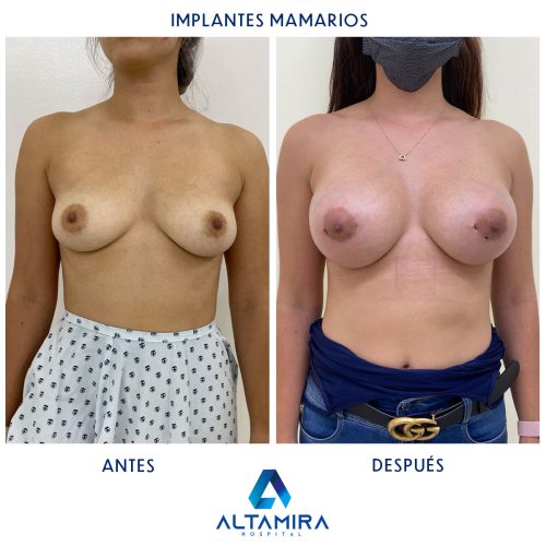 Hospital-Altamira-Galeria-Implantes-Mamarios-002