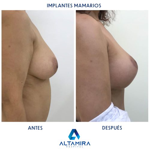 Hospital-Altamira-Galeria-Implantes-Mamarios-003