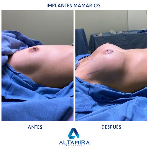 Hospital-Altamira-Galeria-Implantes-Mamarios-004