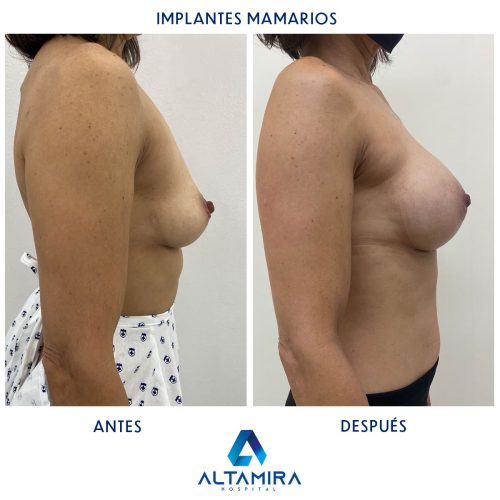 Hospital-Altamira-Galeria-Implantes-Mamarios-005